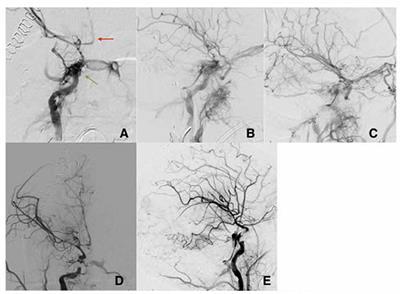 Case Report: Management of Traumatic Carotid-Cavernous Fistulas in the Acute Setting of Penetrating Brain Injury